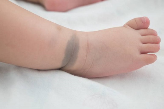 Tìm hiểu ý nghĩa vết chàm, vết bớt với vận mệnh tương lai của bạn